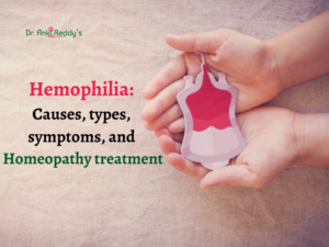 Hemophilia: Causes, types, symptoms, and Homeopathy treatment