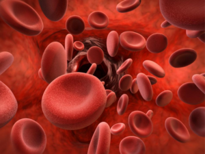 Hemophilia: Causes, types, symptoms, and Homeopathy treatment 