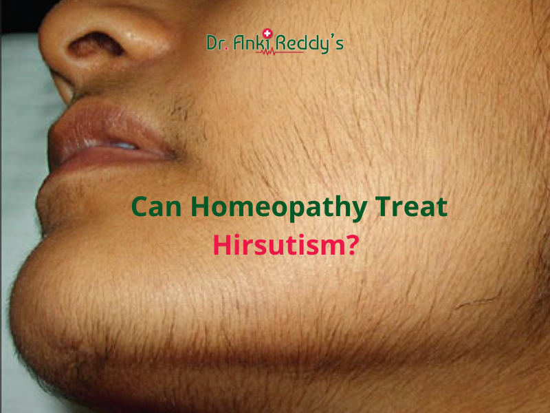 Can Homeopathy Treat Hirsutism?