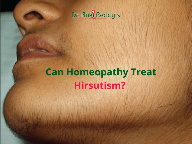 Can Homeopathy Treat Hirsutism?