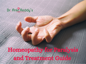 Homeopathy for Paralysis and Treatment Guide