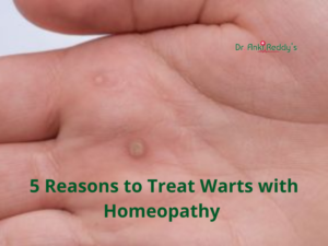 5 Reasons to Treat Warts with Homeopathy