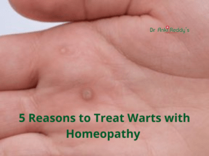 5 Reasons to Treat Warts with Homeopathy 