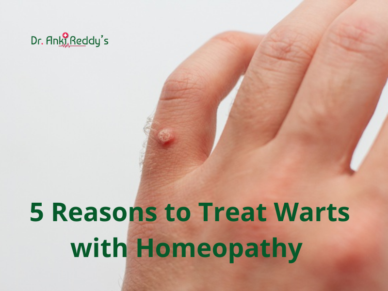 5 Reasons to Treat Warts with Homeopathy