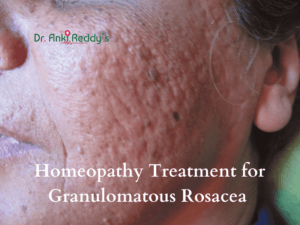 Homeopathy Treatment for Granulomatous Rosacea