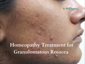 Homeopathy Treatment for Granulomatous Rosacea