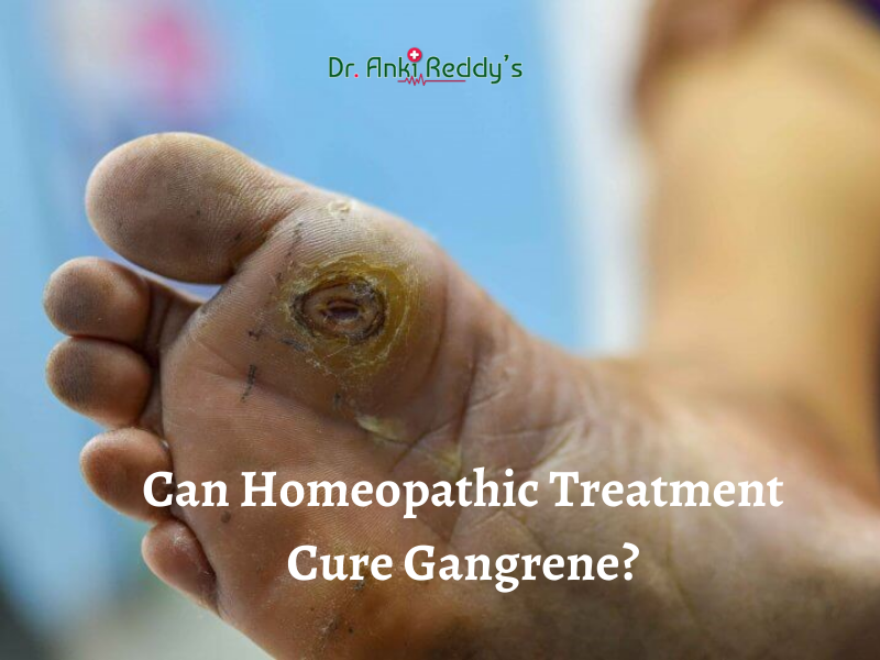 Can Homeopathic Treatment Cure Gangrene?