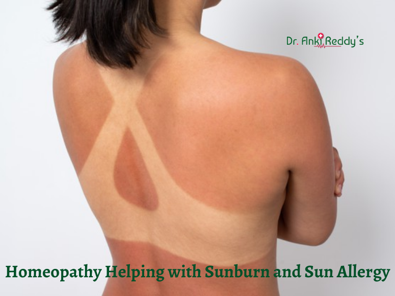 Homeopathy Helping with Sunburn and Sun Allergy