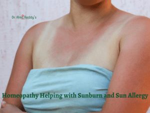 Homeopathy Helping with Sunburn and Sun Allergy