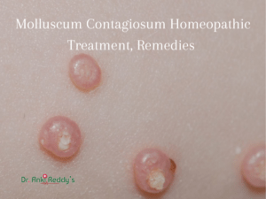 Molluscum Contagiosum Homeopathic Treatment, Remedies 