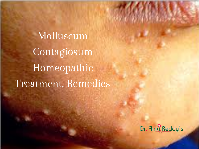 Molluscum Contagiosum Homeopathic Treatment, Remedies