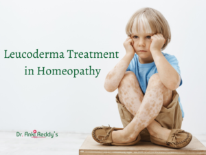 Leucoderma Treatment in Homeopathy