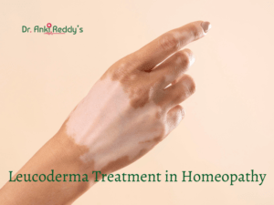 Leucoderma Treatment in Homeopathy