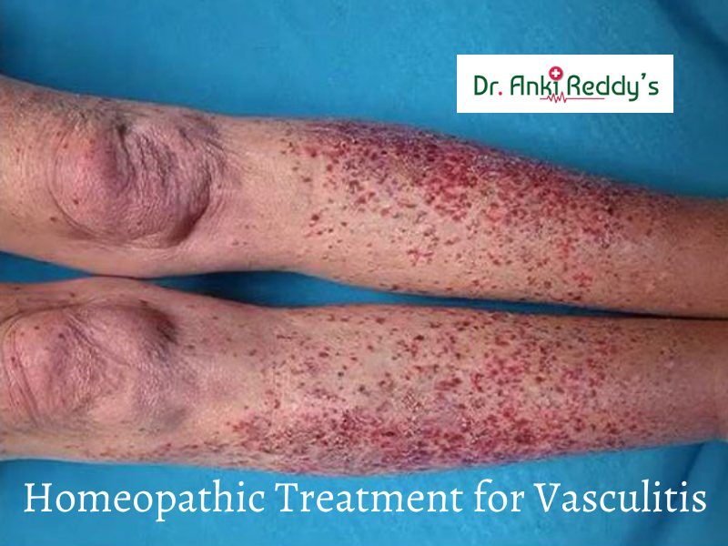 Homeopathic Treatment for Vasculitis