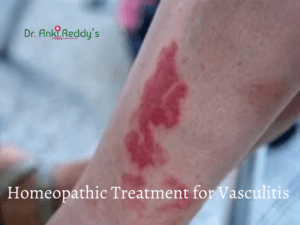 Homeopathic Treatment for Vasculitis