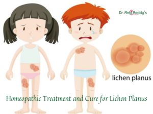 Homeopathic Treatment and Cure for Lichen Planus