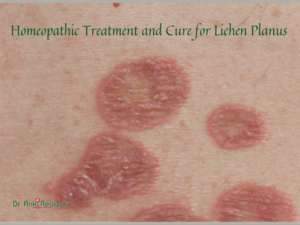 Homeopathic Treatment and Cure for Lichen Planus