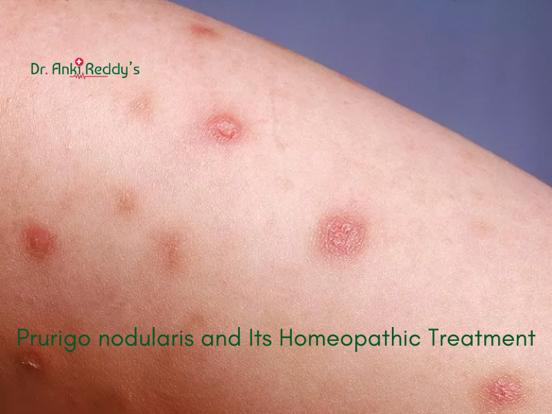 Prurigo nodularis and Its Homeopathic Treatment