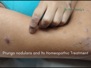 Prurigo nodularis and Its Homeopathic Treatment