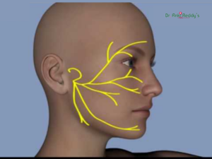 Homeopathy Treatment for Facial Nerve Palsy