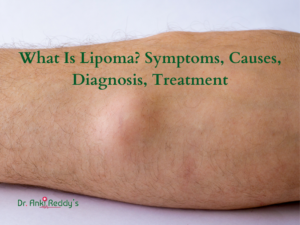 What Is Lipoma? Symptoms, Causes, Diagnosis, Treatment