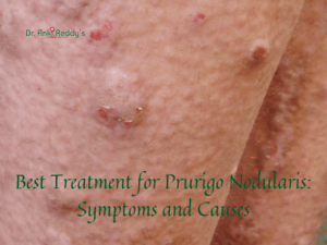 Best Treatment for Prurigo Nodularis: Symptoms and Causes