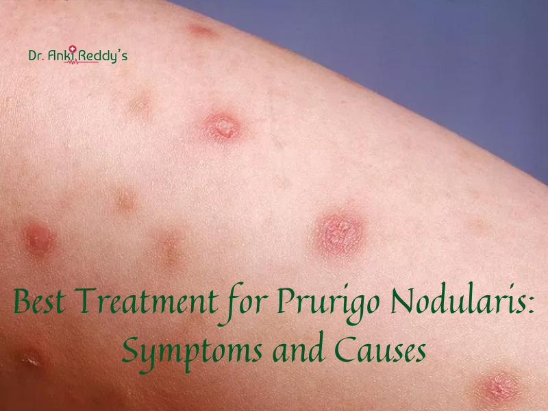 Symptoms and Causes for Prurigo Nodularis