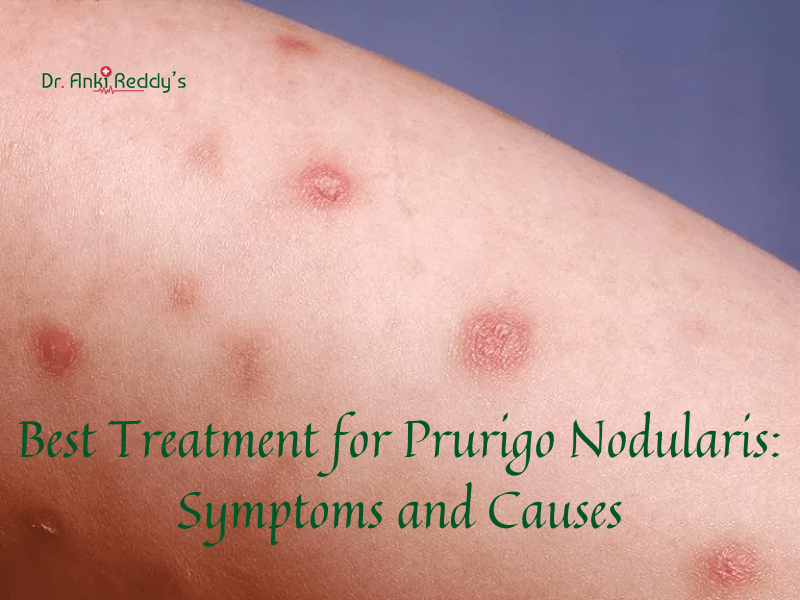 What Is Prurigo Nodularis? Pictures, Causes, Treatment