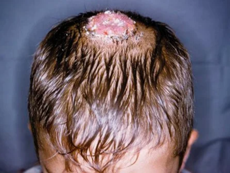 3 Effective Homeopathic Treatment for Scalp Ringworm!