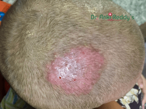 3 Effective Homeopathic Treatment for Scalp Ringworm!