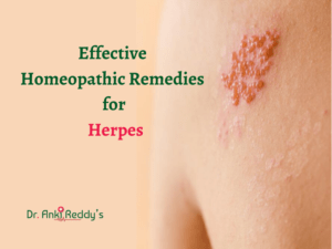 Effective Homeopathic Remedies for Herpes