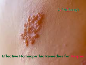 Effective Homeopathic Remedies for Herpes