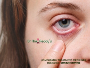 Homeopathy Treatment, Medicines, Remedies - Conjunctivitis