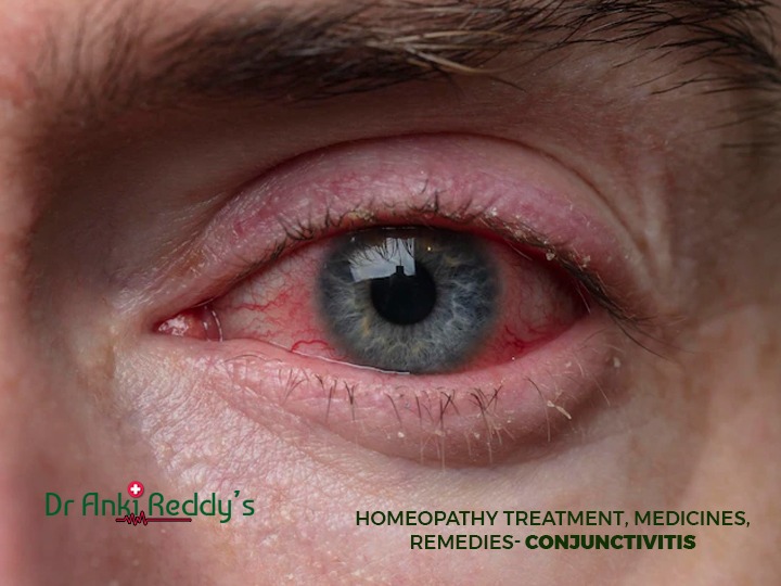 Homeopathy Treatment, Medicines, Remedies- Conjunctivitis
