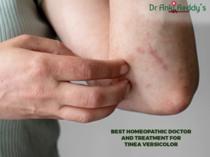 Best Homeopathic Doctor and Treatment for Tinea Versicolor