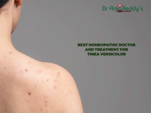 Homeopathic Treatment for Tinea Versicolor