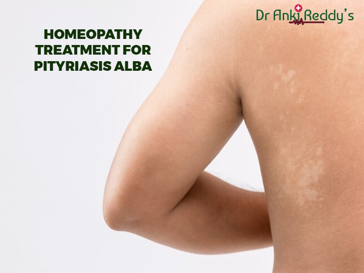Homeopathy Treatment for Pityriasis Alba