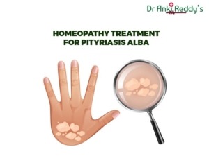 Homeopathy Treatment for Pityriasis Alba