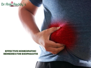 Effective Homeopathic Remedies for Esophagitis