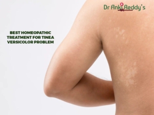 Best Homeopathic Treatment for Tinea Versicolor Problem