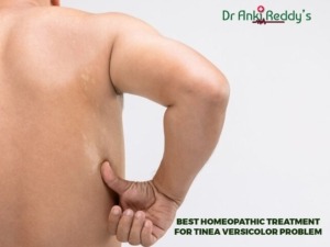 Best Homeopathic Treatment for Tinea Versicolor Problem