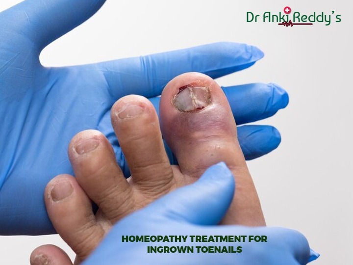 Homeopathy treatment for Ingrown Toenails