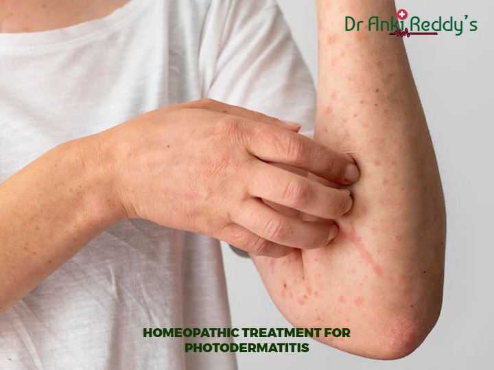 Homeopathic Treatment for Photodermatitis