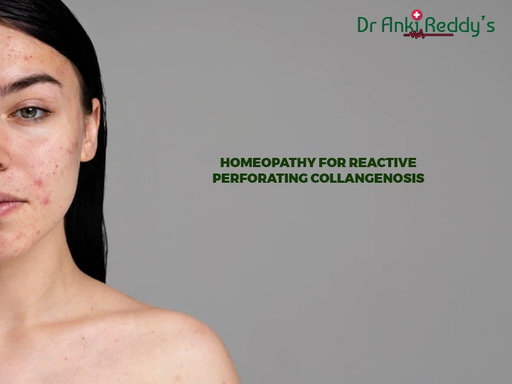 Homeopathy for Reactive Perforating Collangenosis