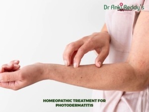 Homeopathic Treatment for Photodermatitis