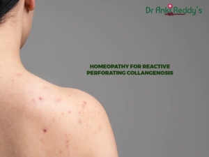 Homeopathy for Reactive Perforating Collangenosis