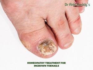 Homeopathy treatment for Ingrown Toenails