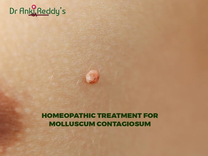 Homeopathic Treatment For Molluscum Contagiosum