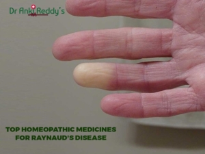 Top Homeopathic Medicines for Raynaud's Disease