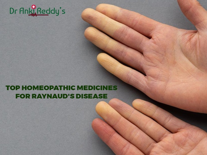 Top Homeopathic Medicines for Raynaud's Disease